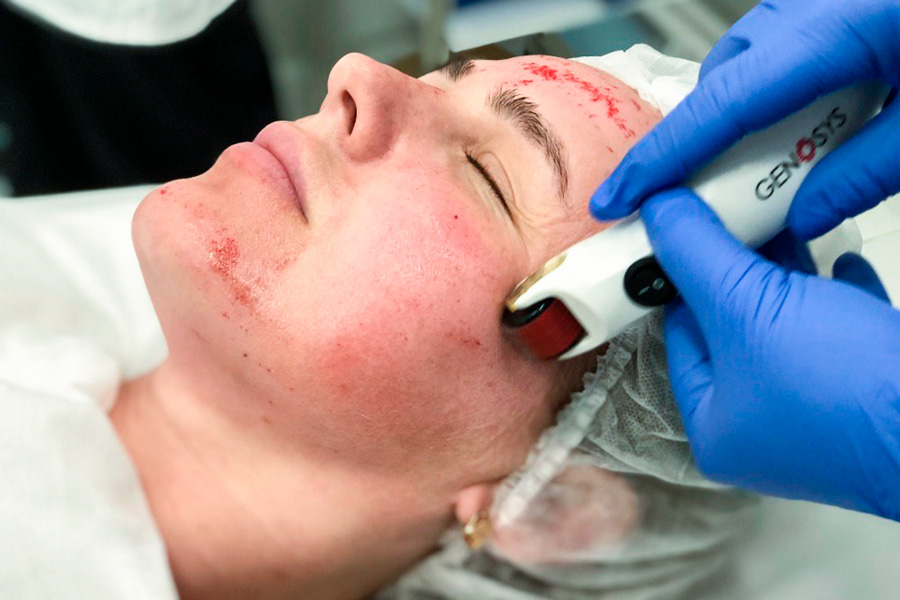 Возможности мезороллеров Genosys® – Gene Re-Birth System в терапевтической косметологии